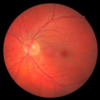 Exame de retinografia. Ele é usado no diagnóstico de glaucoma.