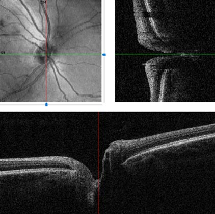 Exame de tomografia de coerência óptica (OCT). Ele é usado no diagnóstico de glaucoma.