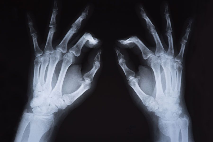 Raios X de mãos com os dedos indicadores flexionados com dor por causa do dedo em gatilho