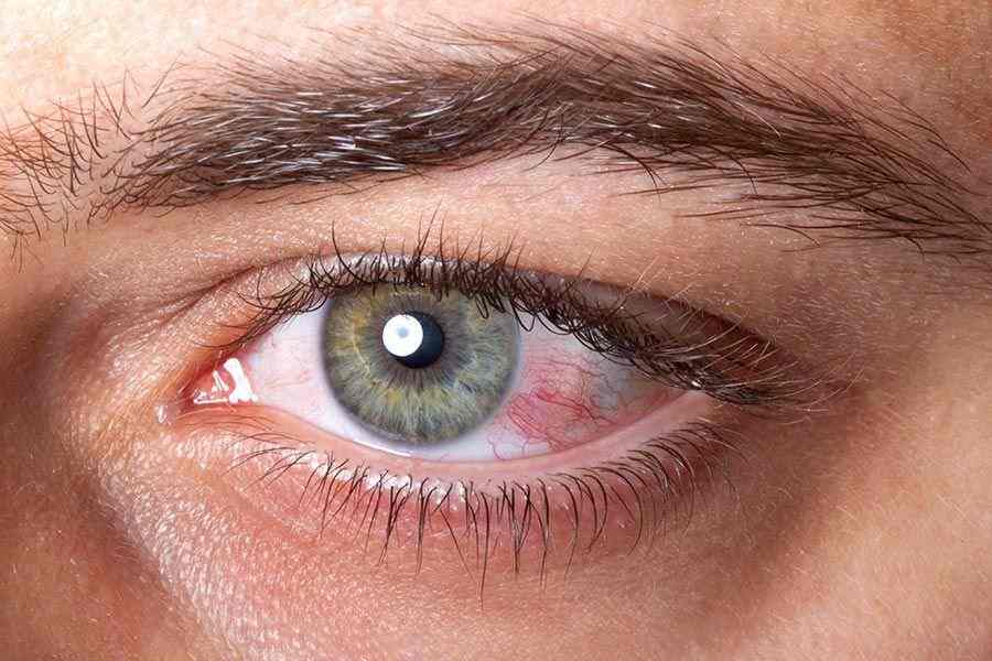 Close de um olho vermelho por causa de uveíte