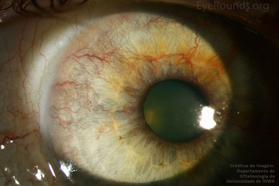 Olho com glaucoma neovascular. Créditos da imagem: Departamento de oftalmologia da Universidade de IOWA