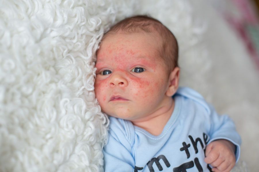 Bebê com manchas vermelhas na pele do rosto