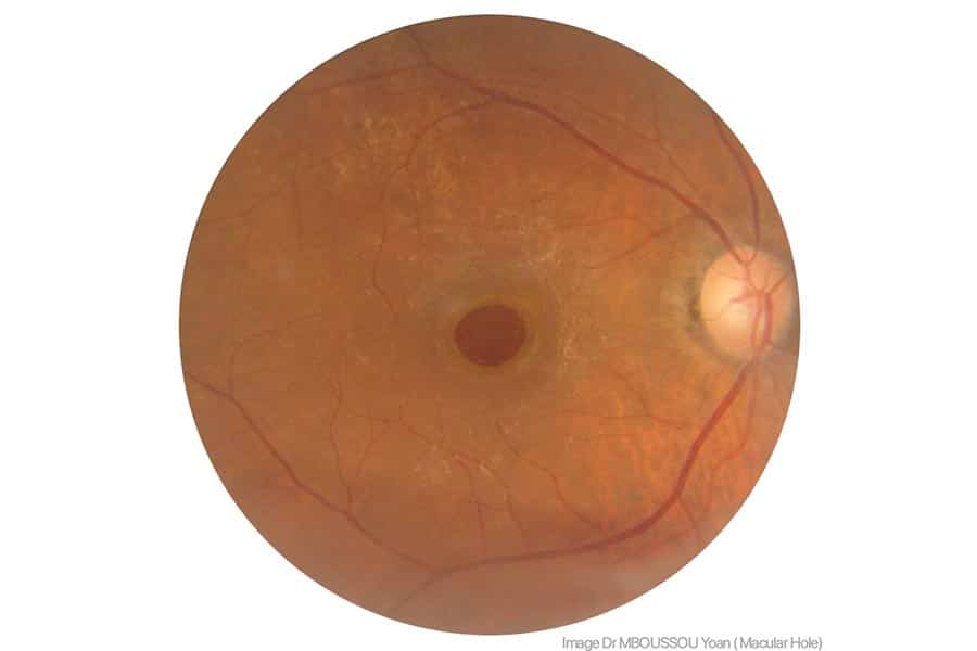 Imagem microscópica de um olho com buraco macular