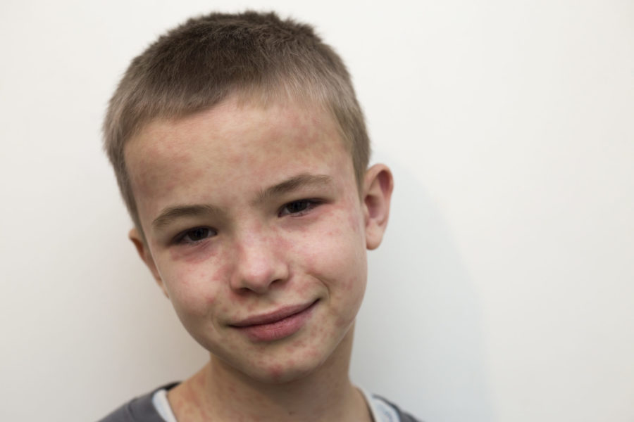 Retrato do rosto de um menino que está com manchas vermelhas por causa da doença mão-pé-boca