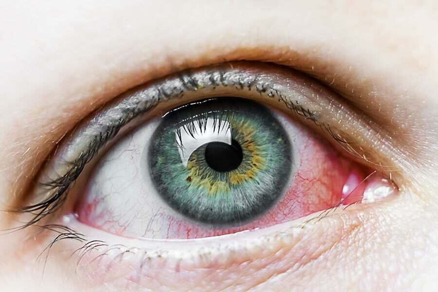Close de um olho vermelho por causa de uma ceratite herpética