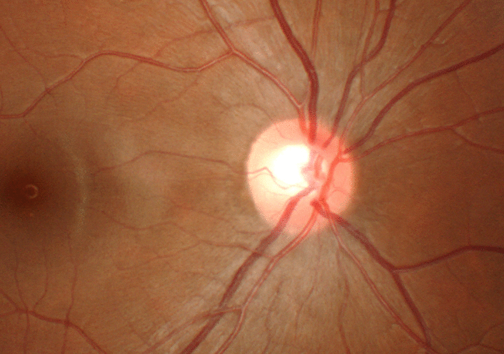 Imagem microscópica de um olho com glaucoma
