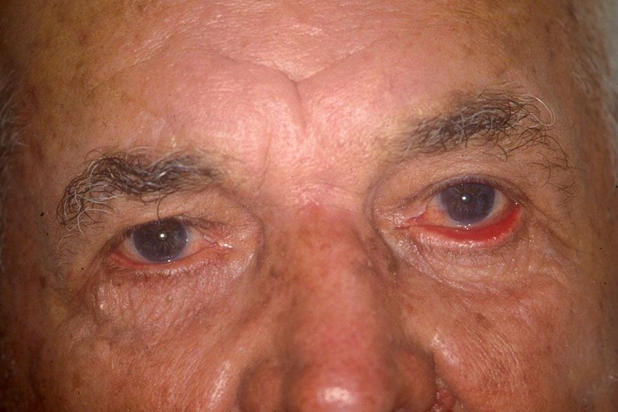Close da pare dos olhos de homem idoso com entrópio e ectrópio nas pálpebras