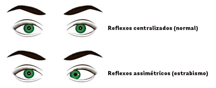 Figura que representa reflexos nos olhos. Nos dois primeiros, o reflexo está centralizado, o que mostra que ele está normal. Nos outros dois o reflexo está assimétrico, indicando estrabismo.