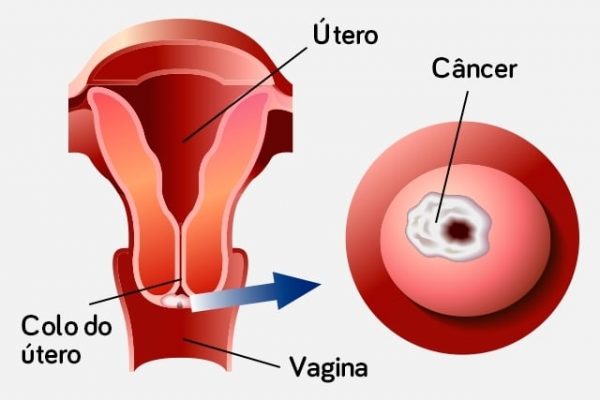 Figura representativa do câncer de colo de útero. Linhas indicam o útero, o colo e a vagina e uma seta aponta para a vista superior na qual está o câncer.